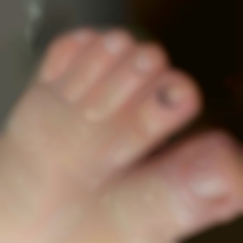 Состояние ногтевых пластин после механической обработки, ног, фото - подолог Яна Владимировна Пичугина