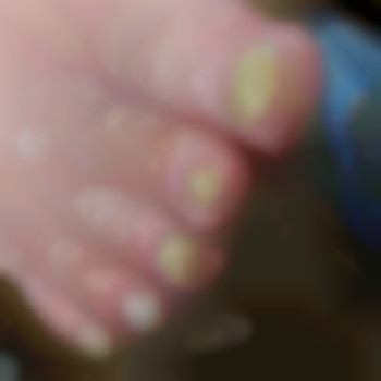 Поражённые ногти грибковой инфекцией, фото - подолог Яна Владимировна Пичугина