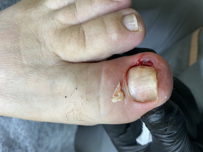 Резекция вросшего ногтя, фото - Подолог Яна Владимировна Пичугина