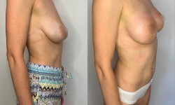 Підтяжка грудей Пластический хирург Тетяна Луцк