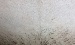 Лікування врослого волосся Мастер эпиляции Наталія Львов