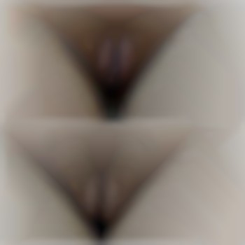 Лабиопластика.
Было произведенно иссечение малых половых губ