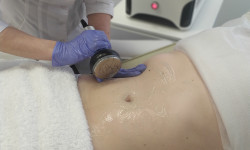 Кавітація Медицинский центр Bilyk - Ultra Laser Хмельницкий