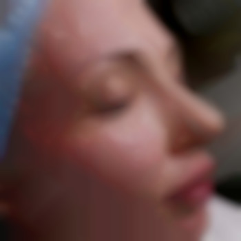 Папулы, фото - косметолог Людмила Чайка