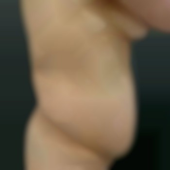 Абдоминопластика - от 2050€ все включено
                    Медичний центр Аура Київ