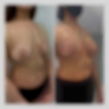 Увеличение груди от 2300€ все включено
                    Медичний центр Аура Київ