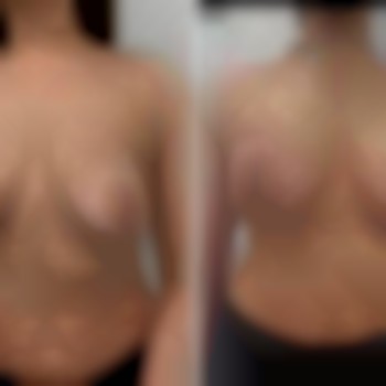 Увеличение груди от 2300€ все включено
                    Медичний центр Аура Київ