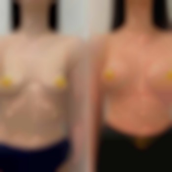 маммопластика