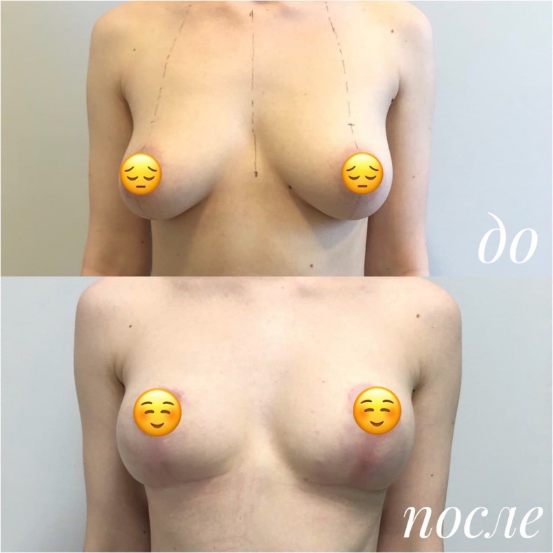 Підтяжка грудей маммопластика, фото - Пластичний хірург Алексей Чернобай