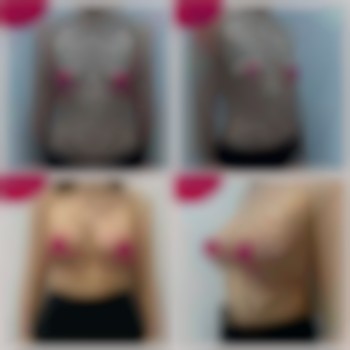 Увеличение груди, коррекция тубулярности, импланты Motiva er