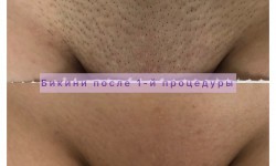 Эпиляция бикини Майстер депіляції Екатерина Герасименко Дніпро