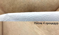 Лазерна епіляція Олександрія Салон краси LASH&BEAUTY STUDIO Олександрія