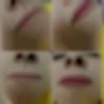 Контурна пластика губ 
Препарат Alexa Hyalual