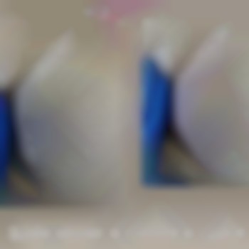 Шугаринг бікіні (коррекція)