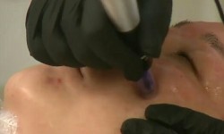 Фракционная мезотерапия Косметолог Инесса Київ