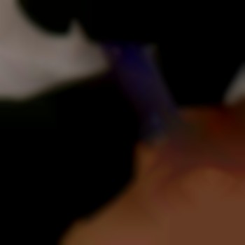 процедура фракционная мезотерапии