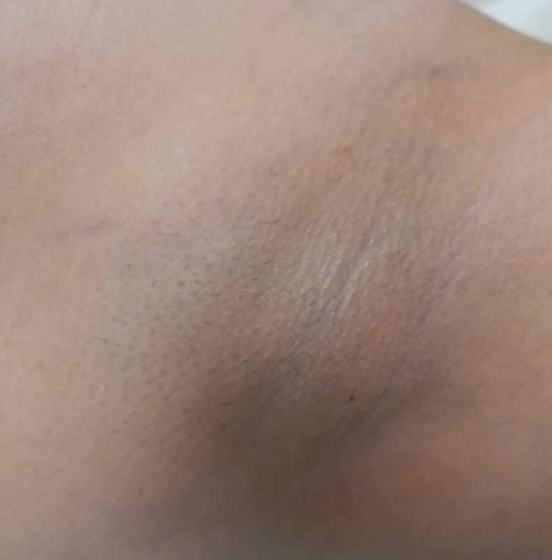 Лазерна епіляція пахви, фото - Косметолог-ін'єкціоніст Альона Туктарова