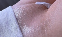 Депиляция глубокого бикини сахарной пастой Майстер депіляції Альона Одеса