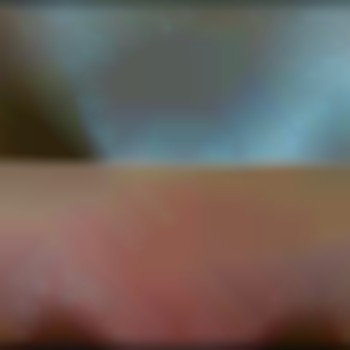 До/після 
Депіляція бікіні