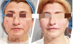 Армування обличчя Косметолог-ін'єкціоніст Виктория Полтава