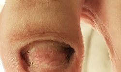 Обробка оніхолізу Подолог Тетяна Одеса