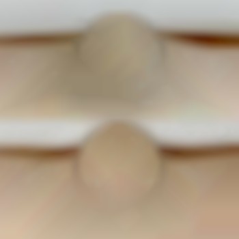 Лазерна епіляція