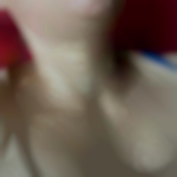 Биоревитализация. Заполнение морщин