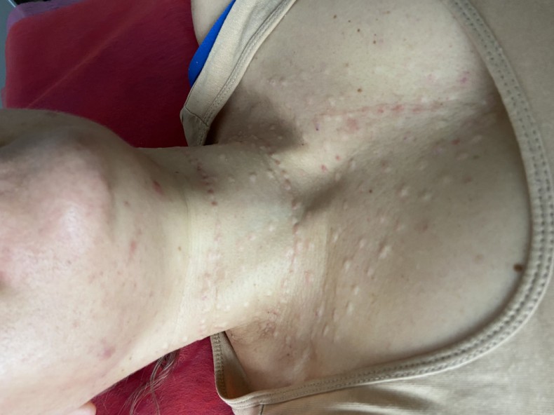 Биоревитализация. Заполнение морщин, фото - Косметолог-ін'єкціоніст Олена Шулаєва