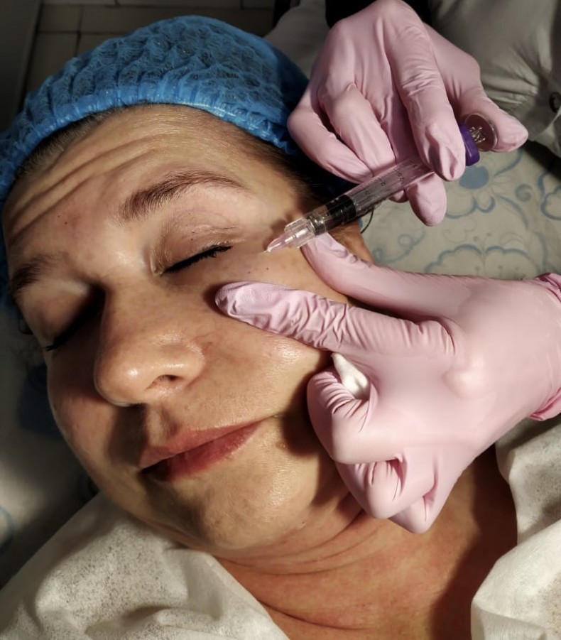 Заполнение морщин, фото - Косметолог-ін'єкціоніст Олена Шулаєва