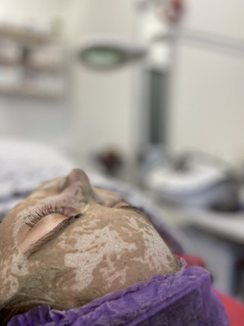 Фитопилинг. Лечение акне, постакне рубцов. Лифтинг, фото - Косметолог-ін'єкціоніст Олена Шулаєва