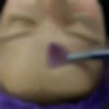 Химические пилинги