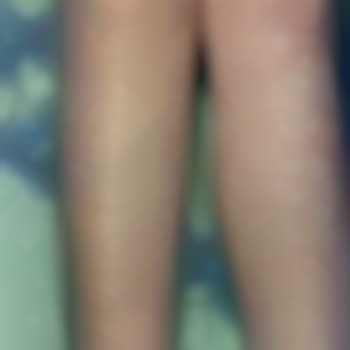 Электроэпиляция тело
                    Майстер депіляції Ирина Харків