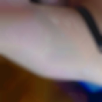 Электроэпиляция с анестезией.