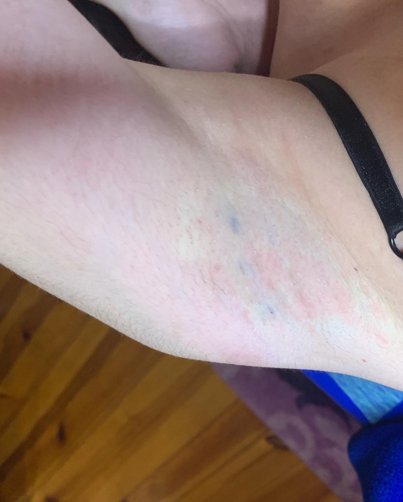 Электроэпиляция с анестезией., фото - Майстер депіляції Ирина Жукова