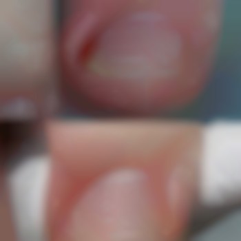 Видалення врослого куточка