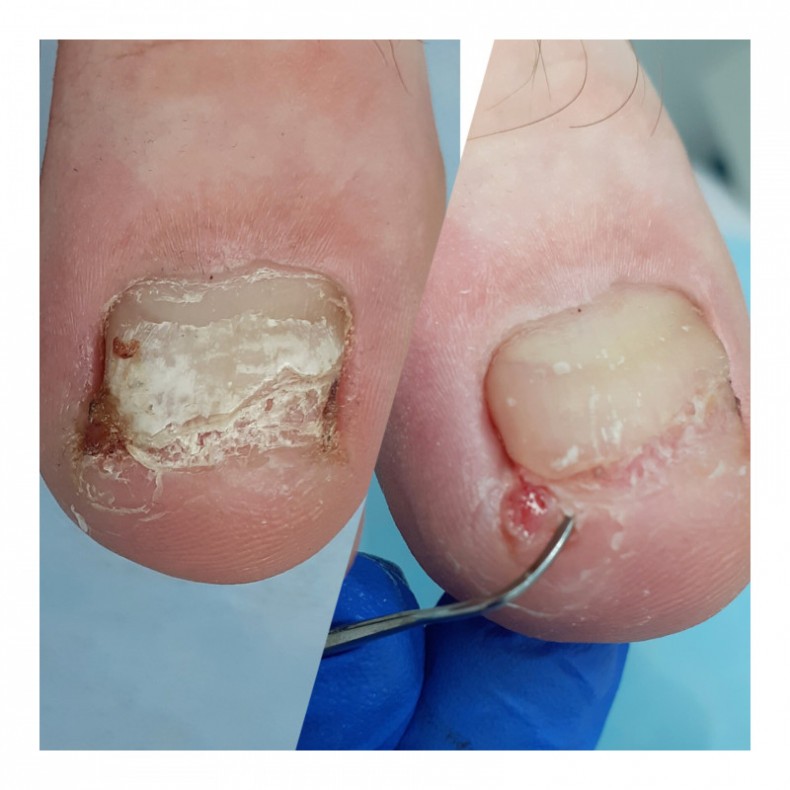 Обробка нігтьової пластини, та усунення врослого куточка, фото - Подолог Тетяна Сметанка