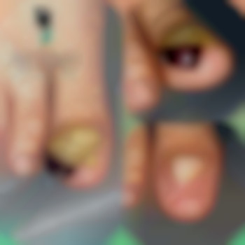 Обробка нігтя при оніхогрифозі