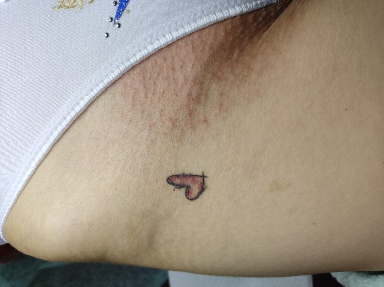 Шкіра після електроепіляції, фото - Майстер депіляції Яна Висідалко