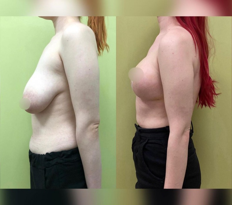 Підтяжка грудей, фото - Пластичний хірург Назар Калинович