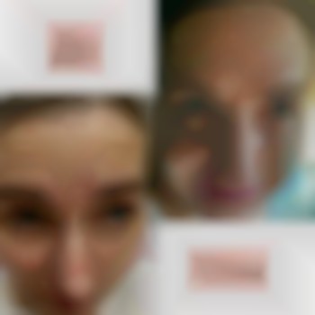 Корекція мімічних зморшок