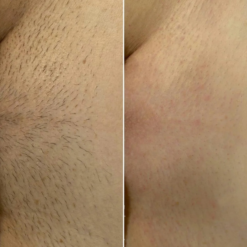 Лазерна епіляція бікіні діодному лазері - 400 грн/сеанс  #лазернаепіляція, фото - Салон краси Майстерня Краси "Юлії Юдіної"