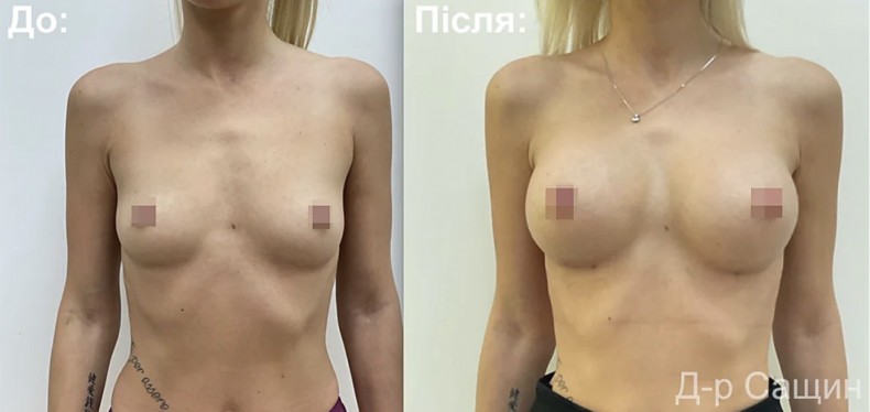 Маммопластика, фото - Пластичний хірург Віктор Сащин