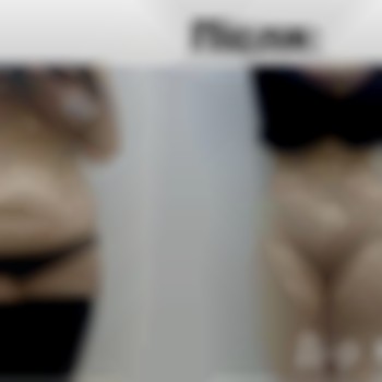 Абдомінопластика (пластика живота)