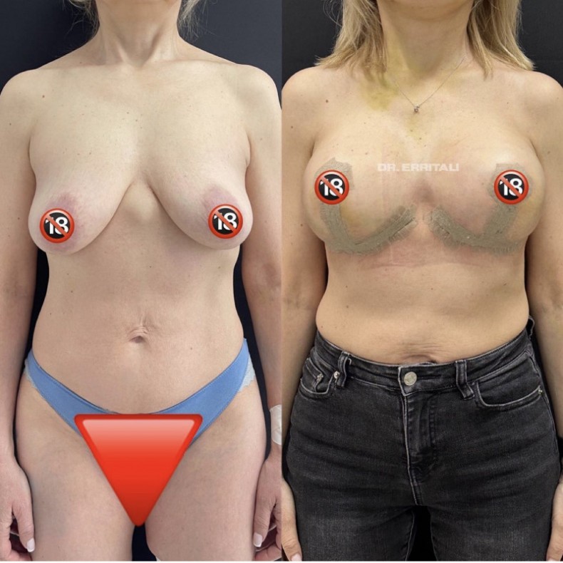 Підтяжка грудей, фото - Пластичний хірург Абдель Эрритали