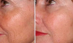 Пилинг Косметолог-естетист Светлана Запоріжжя