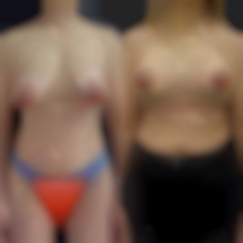 Маммопластика (увеличение груди)
                    Пластичний хірург Абдель Харків