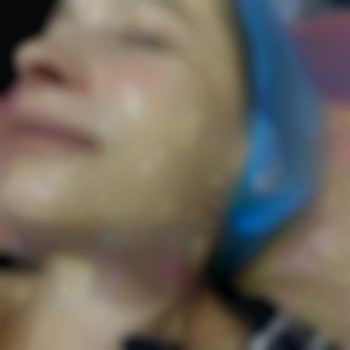 Підтяжка овалу обличчя, фото - косметолог Світлана Юревич