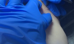 Електроепіляція глибокого бікіні Електролог Яна Полтава