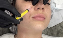 Мезотерапія Косметолог-ін'єкціоніст Дария Київ