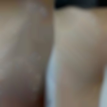 депіляція, лазерна епіляція